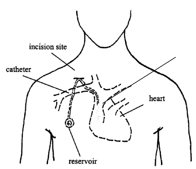 Implanted Port: Care at Home