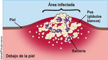 Ilustración que muestra bacterias y pus debajo de la piel, formando un absceso.