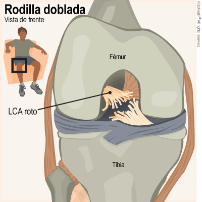 El diagrama muestra el fémur, la tibia y el LCA roto con la rodilla doblada.