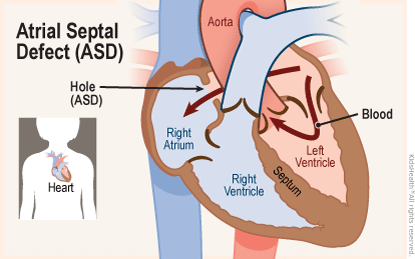 Two diagrams show the position of the heart in the body and a close up, cross section of a heart with an atrial septal defect (ASD). Some blood flows normally from the left atrium into the left ventricle, then on to the aorta.  But a hole in the septum (ASD) also allows blood flow directly from the left atrium into the right atrium.