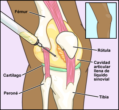 Aspiracion de las articulaciones (artrocentesis)