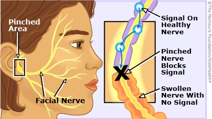 bells palsy illustration