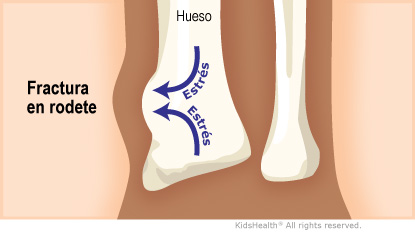 Fractura en rodete