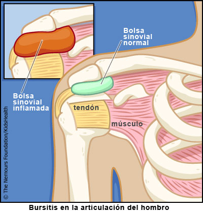 Bursitis en la articulacion del hombro