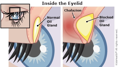 chalazion illustration