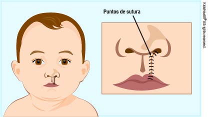 Imagen de la cara de un bebé con puntos de sutura debajo de la nariz. Vista de cerca del área de la nariz y la boca y los puntos de sutura.