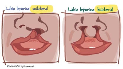 Ilustración que muestra un labio leporino unilateral y un labio leporino bilateral, de la manera que se describe en el artículo.