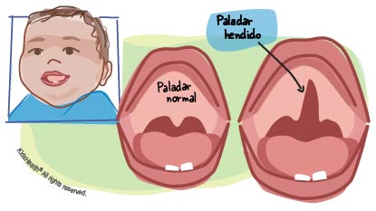 Ilustración que muestra la diferencia entre un paladar normal y un paladar hendido, de la manera que se indica en el artículo