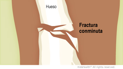 Hueso Comminuted