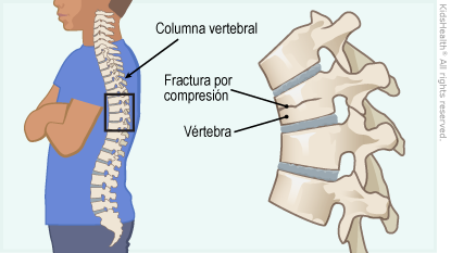 Fractura por compresión