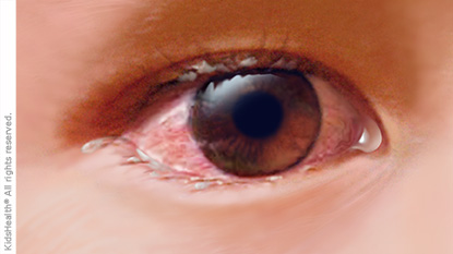 Illustration: Conjunctivitis