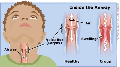 croup illustration