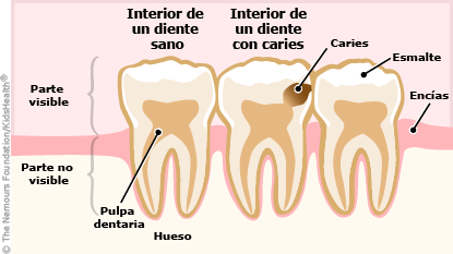 dental cavity illustration