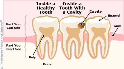 dental cavity illustration