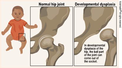 breech presentation hip dysplasia