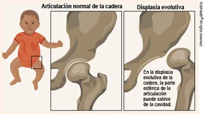 La ilustración muestra el interior de una articulación de cadera normal en comparación con una articulación de cadera con displasia evolutiva. En una cadera con displasia evolutiva, la parte esférica de la articulación puede salirse de la cavidad, de la manera que se indica en el artículo.