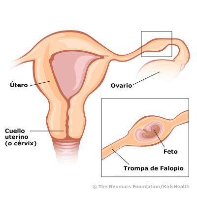 Embarazo ectopico