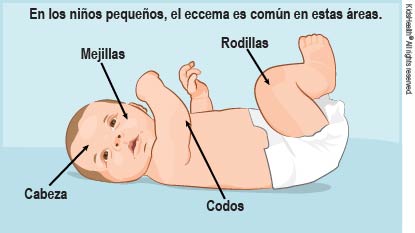 En los niños pequeños, el eccema es común en estas áreas: cabeza, mejillas, codos, rodillas.