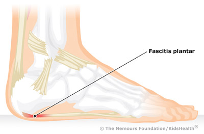 Fascitis plantar