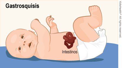 La ilustración muestra los intestinos fuera del abdomen del bebé, tal como se explica en el texto del artículo.