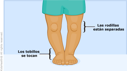 Un niño con piernas arqueadas