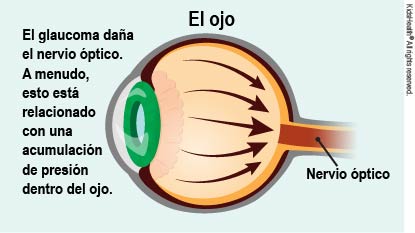 Cuando se acumula presión dentro del ojo, puede provocar glaucoma, como se explica en el artículo.