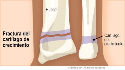 Fractura del cartílago de crecimiento: La ilustración muestra una fractura en la zona del cartílago de crecimiento del hueso.