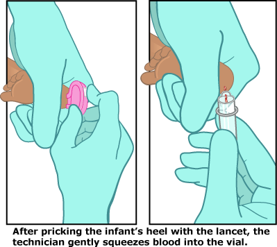 Diagram showing heel prick. After pricking the infant's heel with the lancet, the technician gently squeezes blood into the vial.