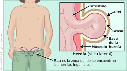La ilustración muestra cómo una parte del intestino pasa a través de una abertura en la parte inferior del abdomen.
