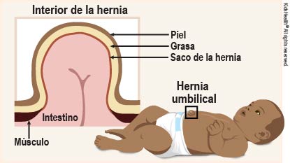 La ilustración muestra a un bebé con una hernia umbilical y el interior de la hernia.