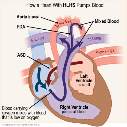 Illustration: How a heart with HLHS pumps blood