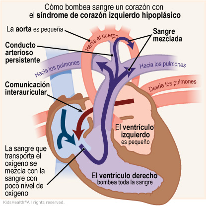 Illustration: How a heart with HLHS pumps blood