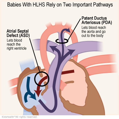 Illustration: Babies with HLHS rely on two important pathways, an ASD and a PDA.