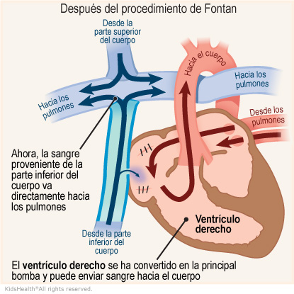 Se muestra cómo funcionan el corazón y la circulación de la sangre después del procedimiento de Fontan. La sangre de la parte inferior del cuerpo ahora va directamente a los pulmones. El ventrículo derecho se ha convertido en la bomba de sangre principal y puede enviar sangre al resto del cuerpo.