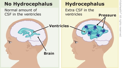 First diagram is no hydrocephalus and shows brain and ventricles with normal amount of CSF in the ventricles. Second diagram is hydrocephalus and shows brain, venticles, increased pressure in ventricles with extra CSF in the ventricles.
