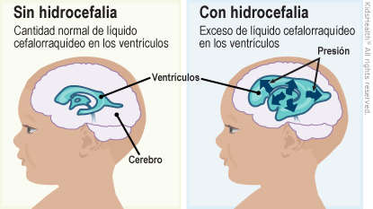 La primera ilustración muestra el cerebro sin hidrocefalia y los ventrículos con una cantidad normal de líquido cefalorraquídeo en los ventrículos. La segunda ilustración muestra el cerebro con hidrocefalia, los ventrículos y un aumento de presión en los ventrículos con un exceso de líquido cefalorraquídeo en los ventrículos.