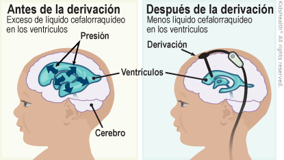 La primera ilustración muestra el cerebro antes de la derivación con un exceso de líquido cefalorraquídeo en los ventrículos. También muestra el cerebro, los ventrículos y el aumento de presión en los ventrículos. La segunda ilustración muestra el cerebro después de la derivación con menos líquido cefalorraquídeo en los ventrículos. También muestra la derivación en los ventrículos.
