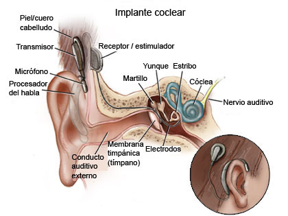 Figura que muestra el implante coclear y las partes del oído humano