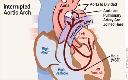 Diagram shows close-up, cross section of the heart with an interrupted aortic arch — a congenital defect where the aorta is divided, the upper portion is normal, but below the aorta and pulmonary artery are joined.  Some blood flows normally from the left atrium into the left ventricle and on through the aorta.  But a hole in the septum separating the two ventricles (VSD) allows blood to flow directly from the left to right ventricle.