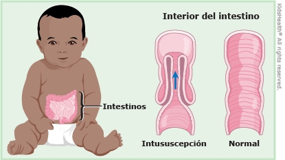 Invaginacion intestinal
