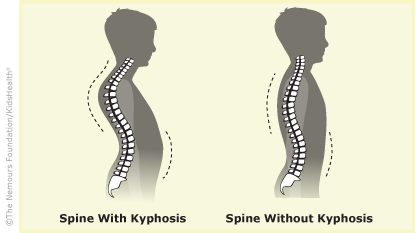 kyphosis illustration