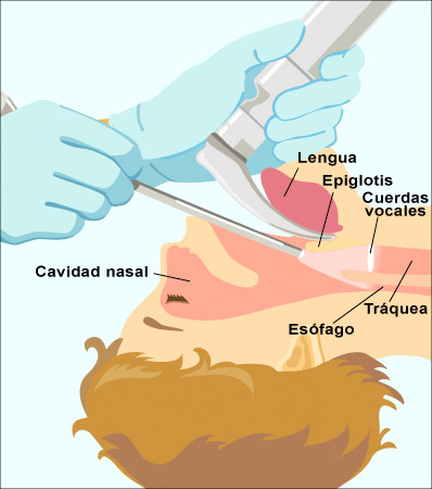 laringoscopia