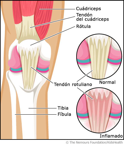 La rodilla de saltador