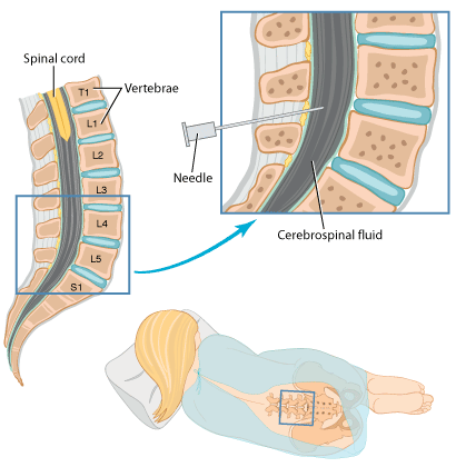 Lumbar Puncture (Spinal Tap)