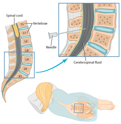 Lumbar Puncture (Spinal Tap) Lumbar Puncture (Spinal Tap)
