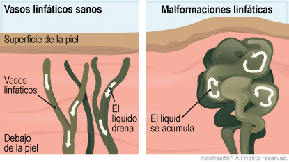 Illustration: Lymphatic Malformation