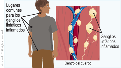 Se muestran lugares comunes en el cuerpo donde hay ganglios linfáticos inflamados (cuello, axila, ingle) y un detalle de los ganglios linfáticos hinchados dentro del cuerpo.