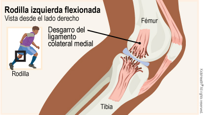 El diagrama muestra una rodilla izquierda flexionada vista desde el lado derecho e indica la ubicación del ligamento colateral medial, el fémur y la tibia.  	 