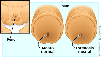Illustration: meatal stenosis