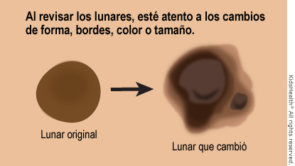 Revise los lunares para ver si hubo cambios